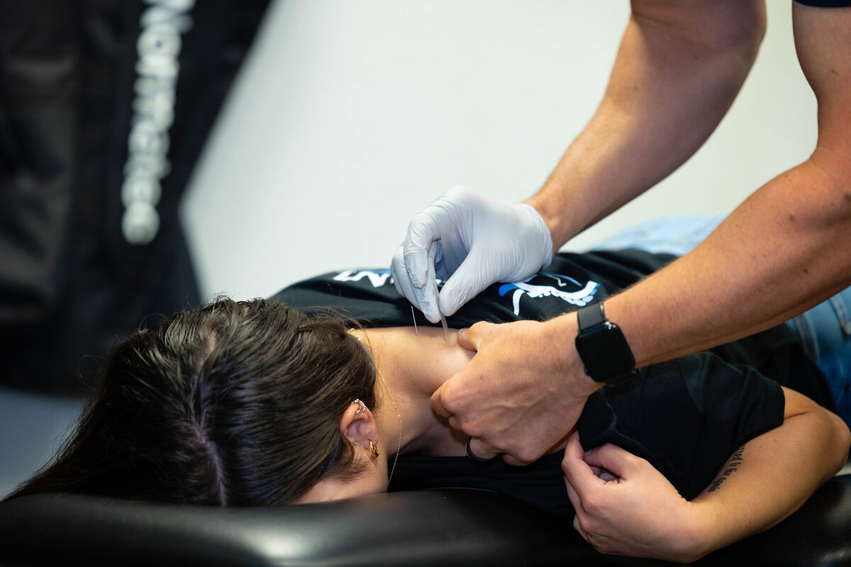 close up of dry needling