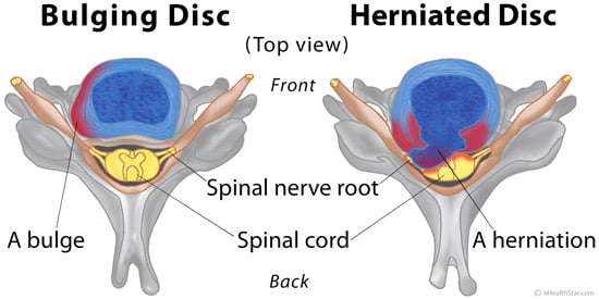 bulging vs herniated disc illustration