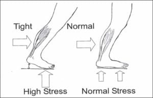 tight calf cause diagram