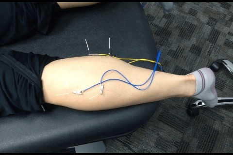 Trigger Point Dry Needling the Calf