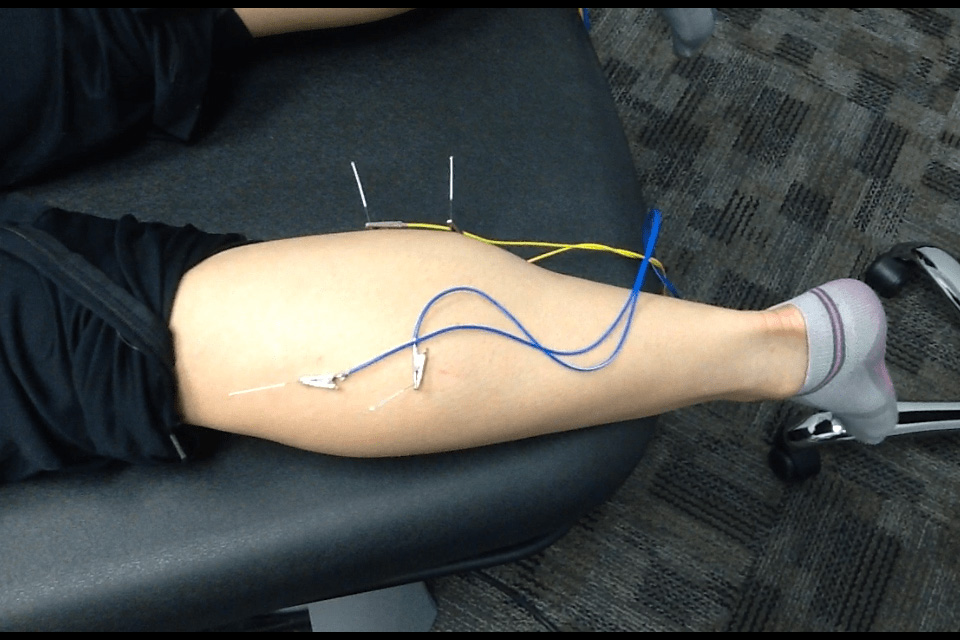 trigger-point-dry-needling-the-calf