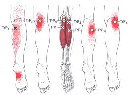 trigger points of the gastrocnemius