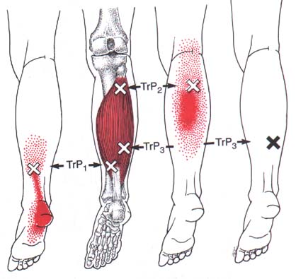 trigger points of the soleus