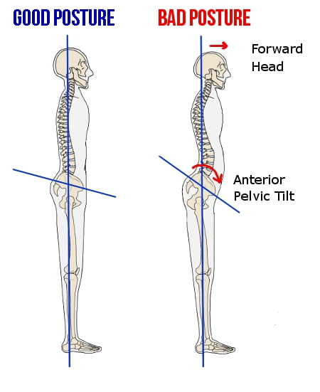 anterior pelvic tilt