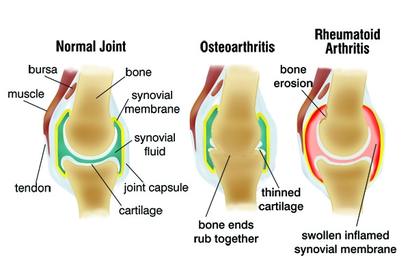 cracking hands arthritis edmonton specialist m7g