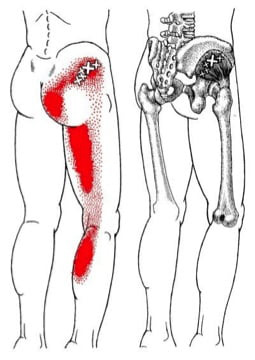 trigger point pain pattern of the glute med