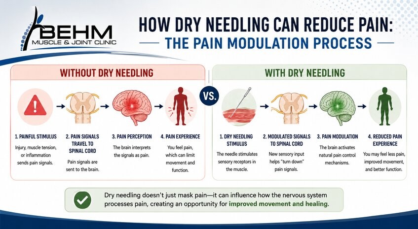 How can dry needling decrease pain