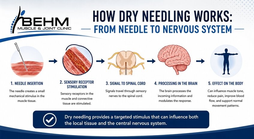 Infographic onWhat Happens Physiologically When a Muscle Is Needled