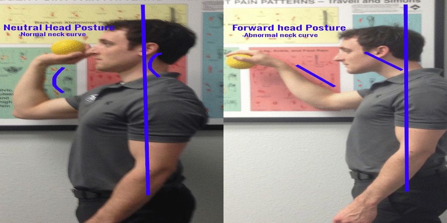 illustration showing forward head posture versus neutral head posture