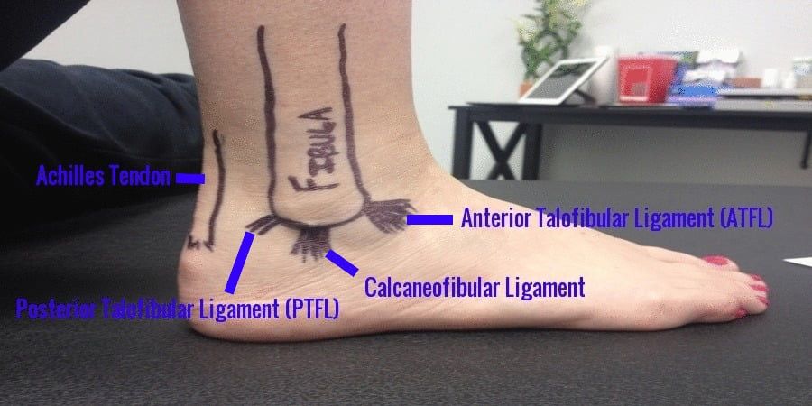 sprained ankle with illustrations and labels
